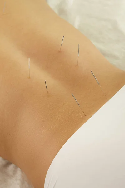 Alternative Medicine Close View Female Back Steel Needles Procedure Acupuncture — Stock Photo, Image