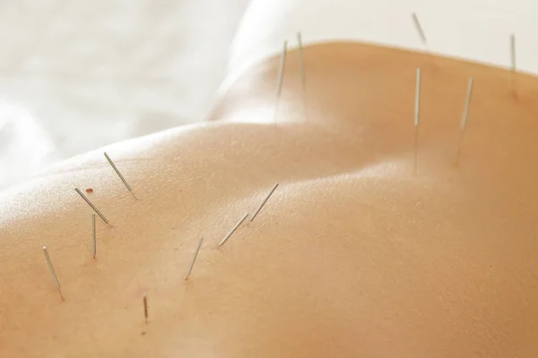 代替医療 鍼治療の手順中に鋼の針でクローズ アップ雌の背中の表示 — ストック写真