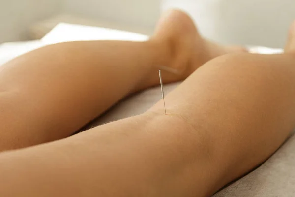 Alternative medicine. Close up view of female legs with steel needles during procedure of acupuncture therapy.