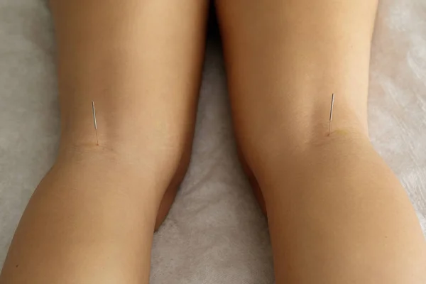 Alternative Medicine Close View Female Legs Steel Needles Procedure Acupuncture — Stock Photo, Image