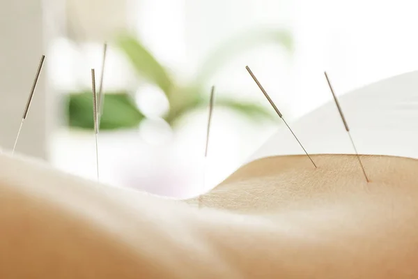 Alternativmedizin Nahaufnahme Des Weiblichen Rückens Mit Stahlnadeln Während Der Akupunkturtherapie Stockfoto