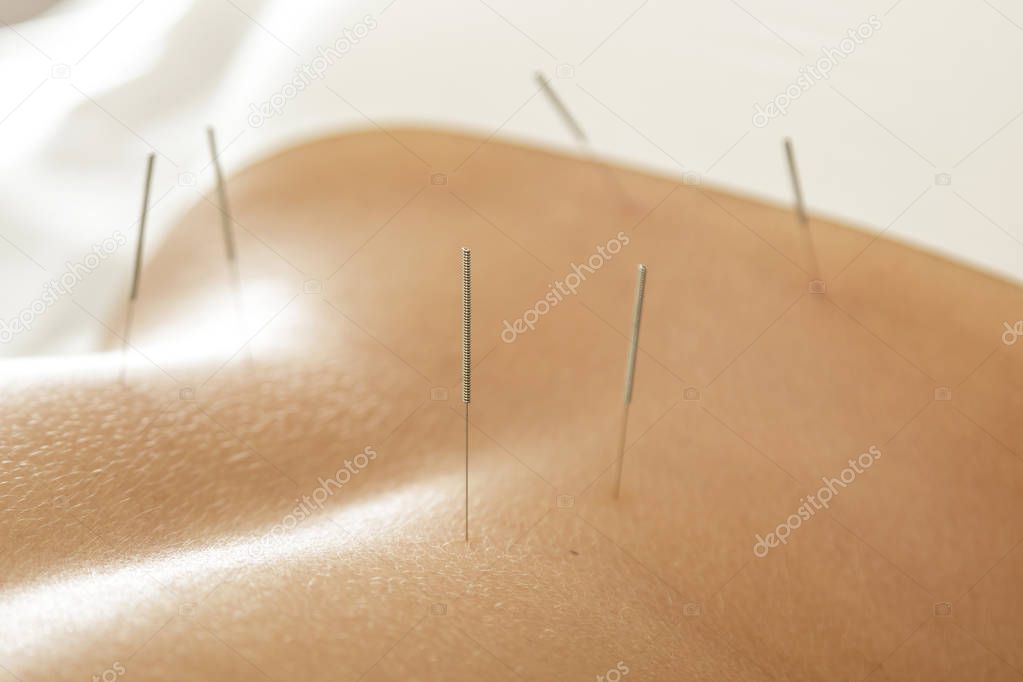 Alternative medicine. Close up view of female back with steel needles during procedure of acupuncture therapy