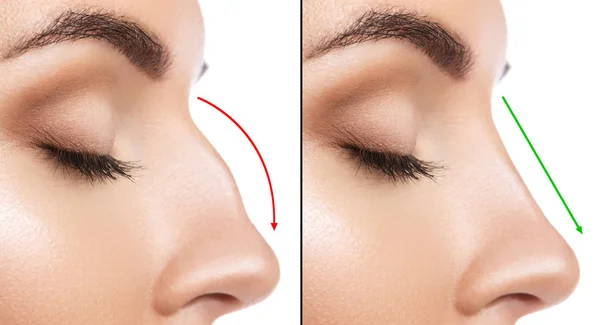 Сравнение Женского Носа После Пластической Операции — стоковое фото