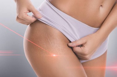 Lazer çıkarma seansı tedavisi sırasında çatlaklar