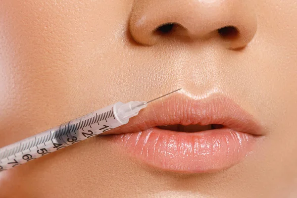 Female lips and syringe with a filler — Stock Photo, Image