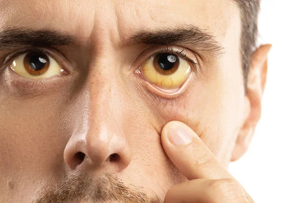 Yellowish eyes is sign of problems with liver, viral infection o Royalty Free Stock Images