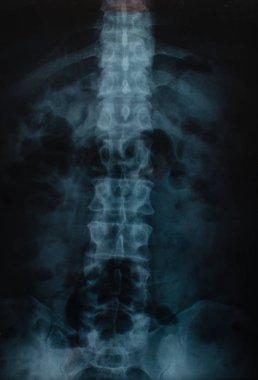 X-Ray görüntü kalça tıp kavramı