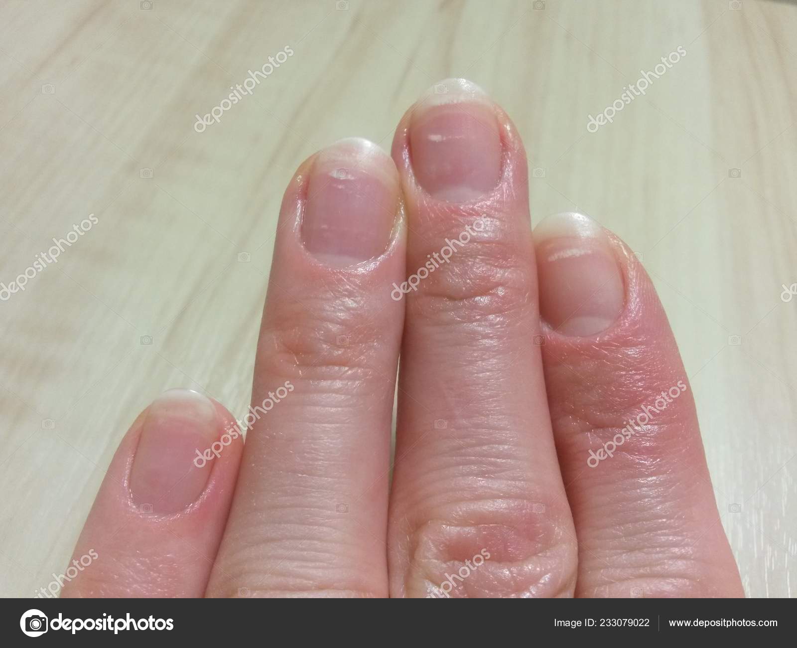 White Spots Nails Due Lack Vitamins Spring Stock Photo by  ©lis197980@ 233079022