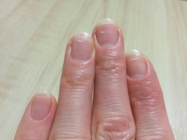 Beyaz lekeler çivi vitamin eksikliği nedeniyle baharda
