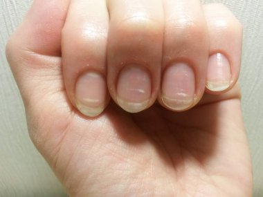 Beyaz lekeler çivi vitamin eksikliği nedeniyle baharda