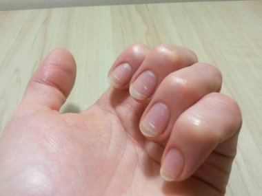 Beyaz lekeler çivi vitamin eksikliği nedeniyle baharda