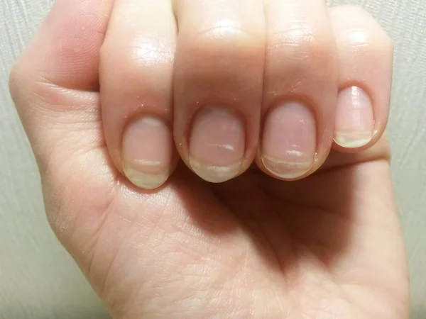 Witte Vlekken Nagels Wegens Gebrek Aan Vitaminen Het Voorjaar — Stockfoto