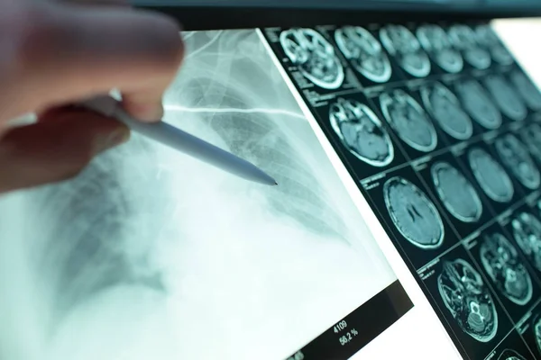 医生点与笔的 射线图像的肺部挂在 Negatoscope Mri 图像的头部 — 图库照片
