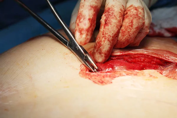 Kéz Eszközzel Sebész Kezeli Mély Kárt Beteg — Stock Fotó