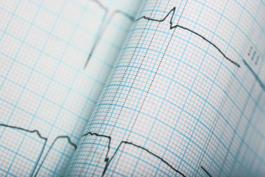 EKG satırlarında çökmekten grafik kağıdı yakın çekim.