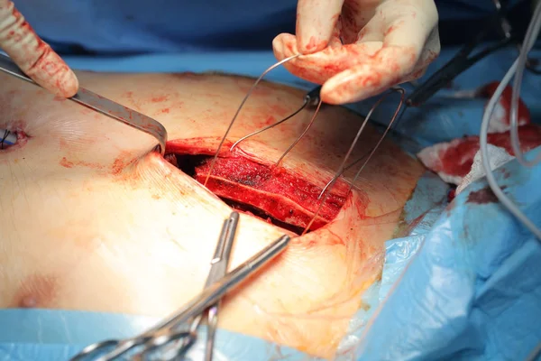 Le chirurgien réalise l'ostéosuture du sternum dur du patient — Photo