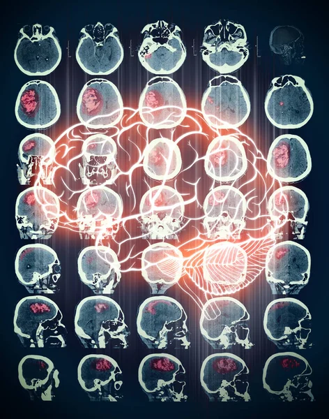 Röd Markerade Zonen Datortomografi Hjärnan — Stockfoto