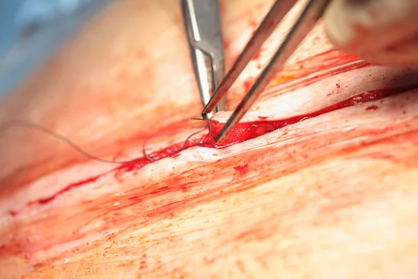 Proceso Sutura Heridas Como Parte Tratamiento Quirúrgico — Foto de Stock