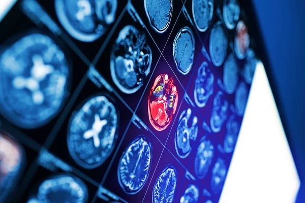 Imagen Resonancia Magnética Cerebro Humano Con Área Roja —  Fotos de Stock