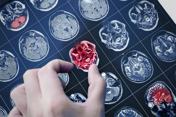 Imagem Ressonância Magnética Cérebro Paciente Com Mão Médico Apontando Para — Fotografia de Stock