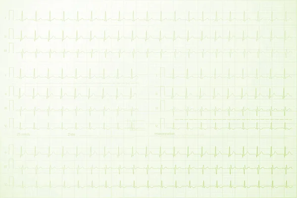 Καρδιογράφημα Γραμμές Στο Χαρτί Φόντο Εικόνα — Φωτογραφία Αρχείου