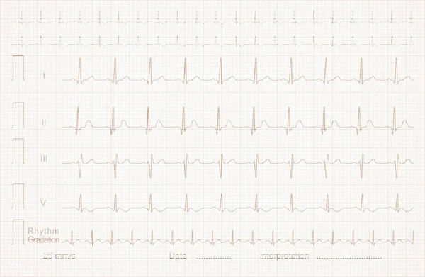 Ecg Cardiograma Papel Gráfico Lineal —  Fotos de Stock