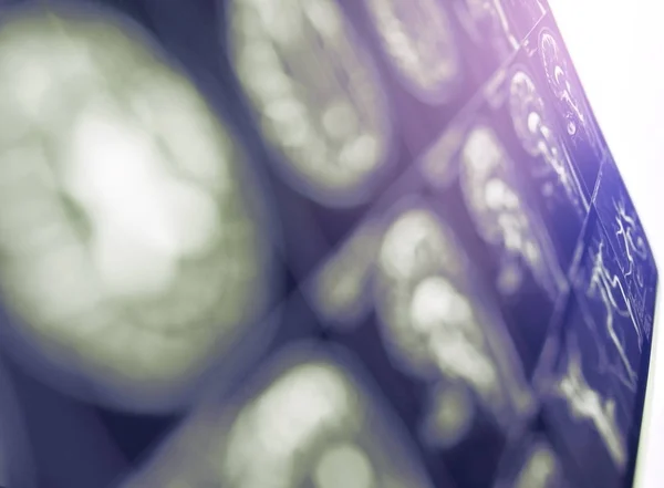 Odaklanmamış bir tıbbi arka plan olarak beynin MRi görüntü — Stok fotoğraf