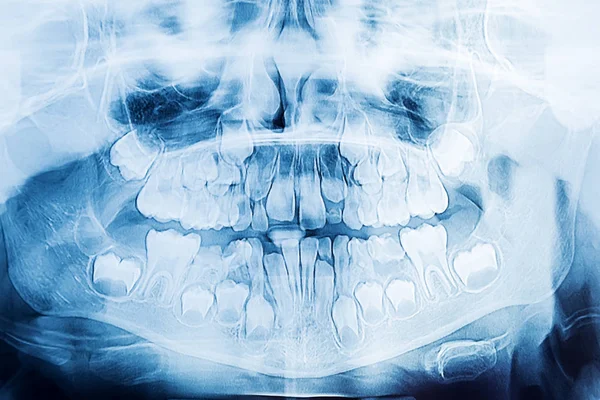 Crianças Radiografia Dentária — Fotografia de Stock