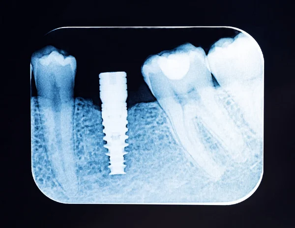 关闭牙科 射线螺钉植入物 — 图库照片