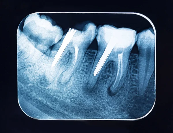 Dental Röntgen Tänder Med Dentala Pivot — Stockfoto