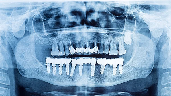 Radiografia Dental Panorâmica Mandíbula Superior Inferior Prótese Implante Dentário — Fotografia de Stock