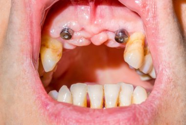Gelişmiş p olan bir hastaya ağzına köpek Diş implantları