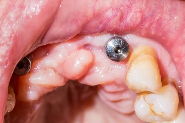 Une macro-injection d'implant dentaire dans la bouche d'un patient avec annonce — Photo