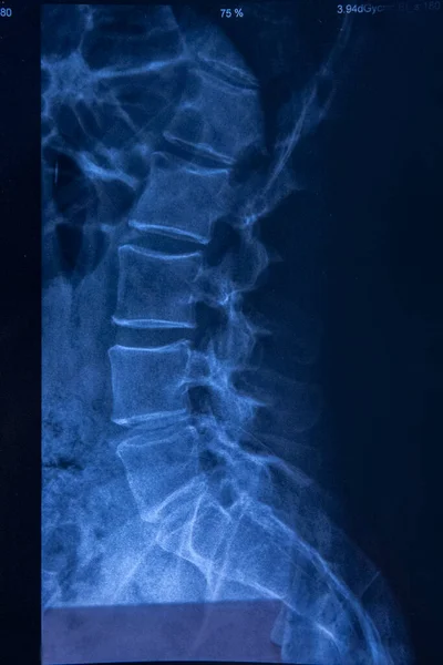 X-ray of human cervical spin. Lateral View.