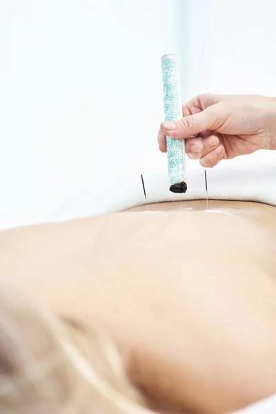 Woman being treated with acupuncture and moxibustion treatments — Stock Photo, Image