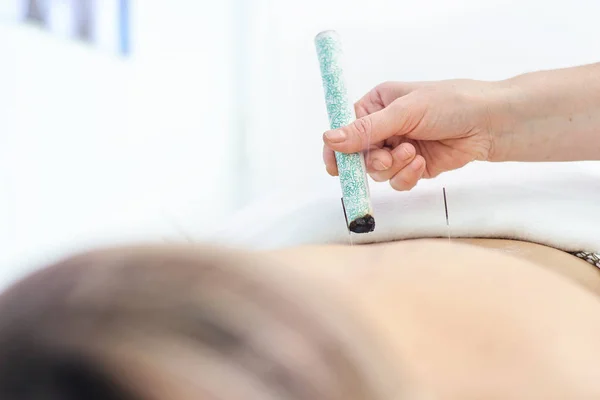 Woman being treated with acupuncture and moxibustion treatments