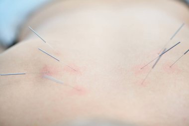Alternatif Tıp. Akupunktur tedavisinin yordamı sırasında çelik iğneler ile kadın geri Close-up.