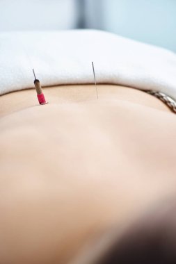 Akupunktur ve moxibustion tedavi ile tedavi altına kadın