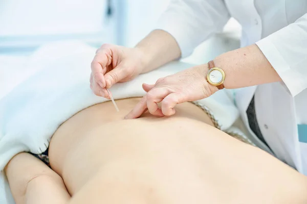 Detalle macro de la mano femenina usando un tubo de inserción para insertar una aguja de acupuntura Goshin en la parte posterior de una paciente femenina . —  Fotos de Stock