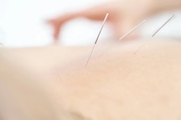 Médecine alternative. Gros plan du dos féminin avec des aiguilles en acier pendant la procédure de traitement par acupuncture . — Photo