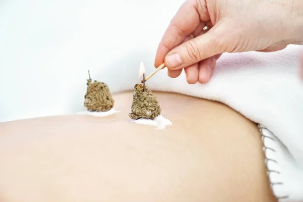 Frau wird mit Akupunktur und Moxibustion behandelt Stockbild