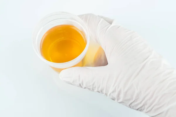 Urinalisis Cangkir Dengan Urin Memegang Tangan — Stok Foto