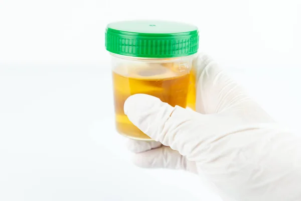 İdrar tahlili, idrar örneği.