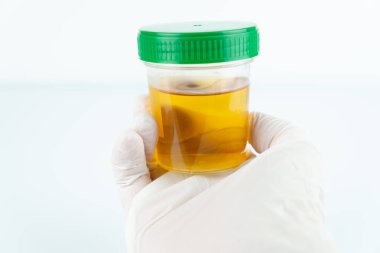 İdrar tahlili, idrar örneği.