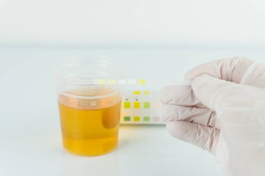 Kontrol edin, rutin idrar tahlili, idrar tahlili için ayırıcı. 