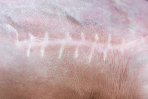 Cicatriz Com Pontos Pulso Após Cirurgia Fratura Dos Ossos Das — Fotografia de Stock