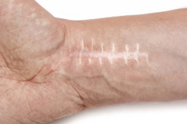 Cicatriz Com Pontos Pulso Após Cirurgia Fratura Dos Ossos Das — Fotografia de Stock