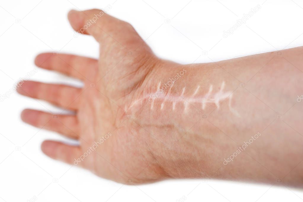 Scar with stitches on the wrist after surgery. Fracture of the bones of the hands in fist isolated on white background