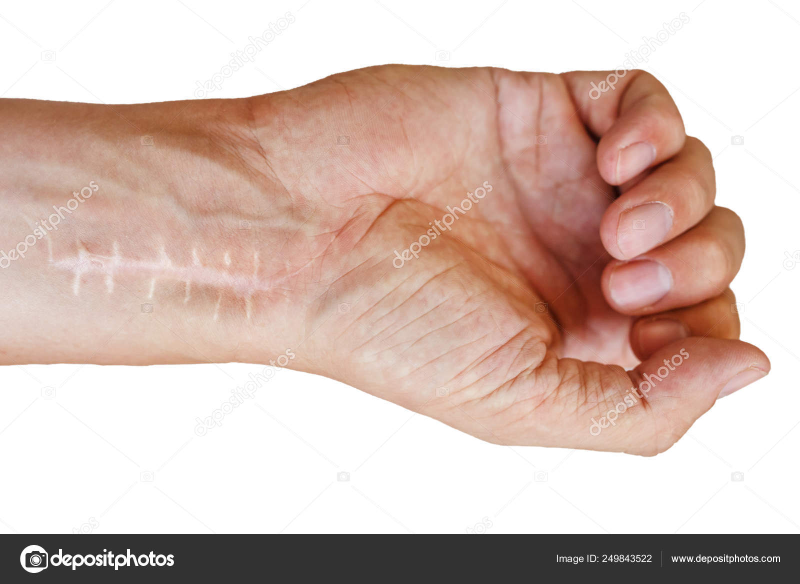 Scar with stitches on the wrist after surgery. Fracture of the bones of