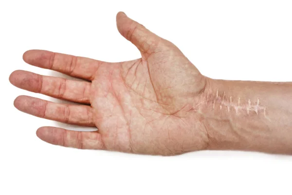 Scar with stitches on the wrist after surgery. Fracture of the bones of the hands isolated on white background — Stock Photo, Image